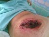 glute-abscess3.jpg