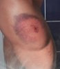 hematoma-day-2.jpg hematoma-day-2.jpg