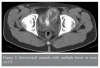 Unusual-foreign-body-in-the-vesico-urethral.gif