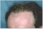 hair-transplant-history.webp