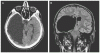 Arachnoid-Cyst.gif