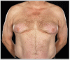 Bicalutamide-Gynecomastia.gif