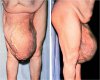 Large Right Inguinal Hernia.jpg