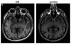 achiasma.gif