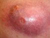 Pilonidal-Abscess-Treatment-1.jpg