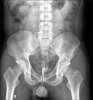 Kidney-ureter-bladder abdominal radiography.jpg