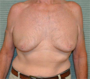 gynecomastia%20grade%203%20front%20view%20before%20closeup.jpg