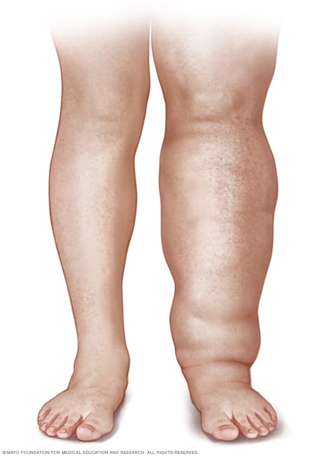 r11_lymphedema-8col.jpg