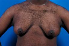 p12-front-before-male-breast-reduction.jpg