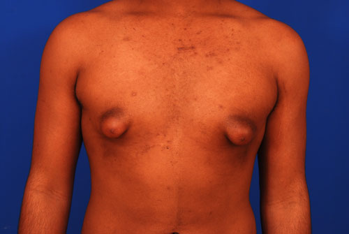 gynecomastia-and-tubular-breast-condition.jpg