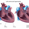 Anabolic steroids and left ventricular hypertrophy of the heart