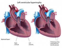 Anabolic Steroids, Growth Hormone, and Hypertrophy of the Heart - MESO-Rx