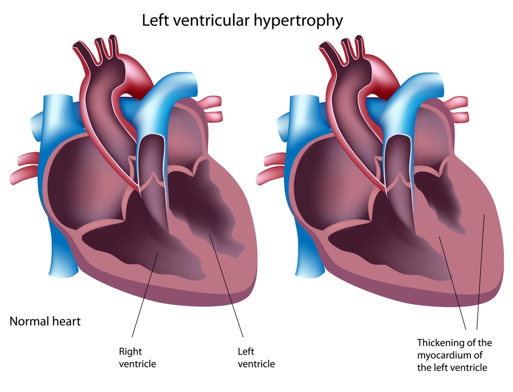 Анаболические стероиды и гипертрофия левого желудочка сердца