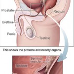 Prostate Health on Testosterone Replacement Therapy